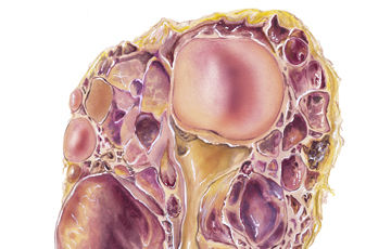 Polycystic Kidney